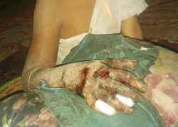 クサリヘビ科のヘビ（出血毒）による咬傷被害の事例／ガラガラヘビに咬まれた少年の右手