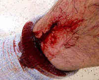 アカエイの刺傷被害事例　足の傷口