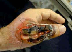 ドクイトグモに咬まれた手の症状／ドクイトグモ咬症（実例写真）