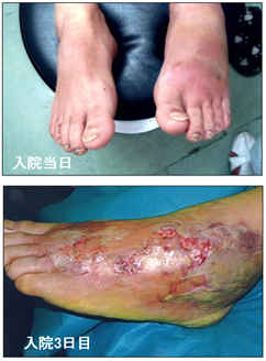 劇症型溶血性レンサ球菌感染症に感染した50歳代男性の左足